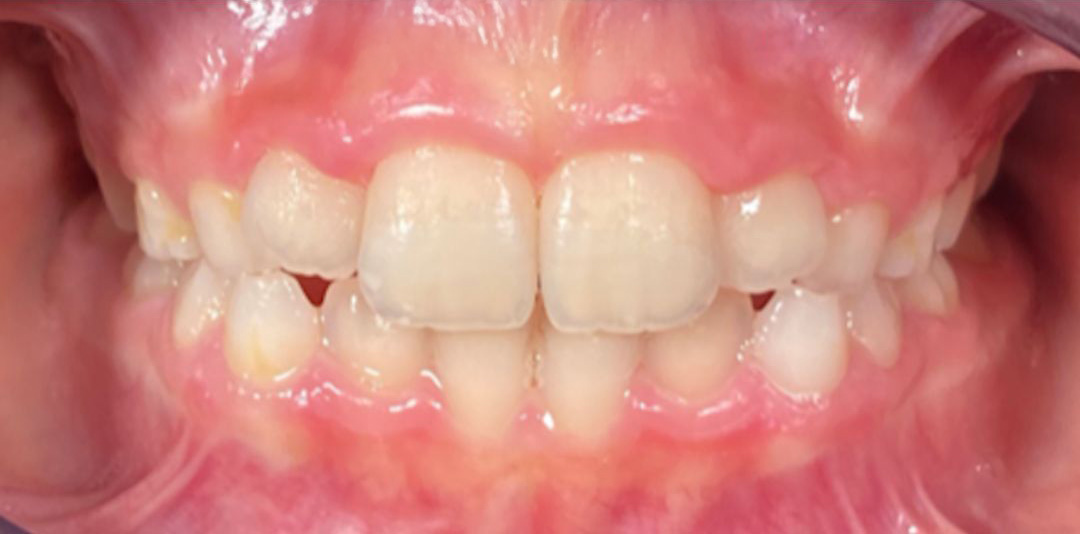 Stav zubov po 8 mesiacoch terapie dentosofie – detailný pohľad