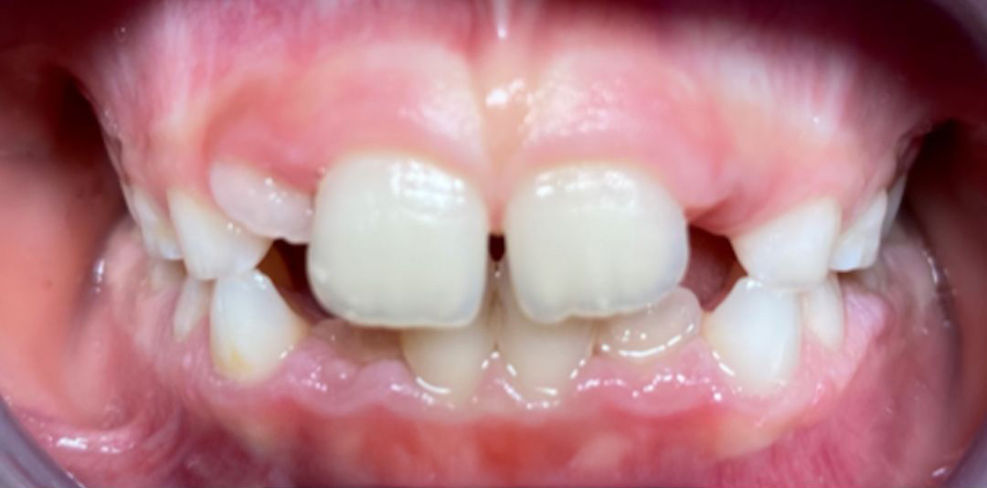 Stav zubov pred terapiou dentosofie – detailný pohľad