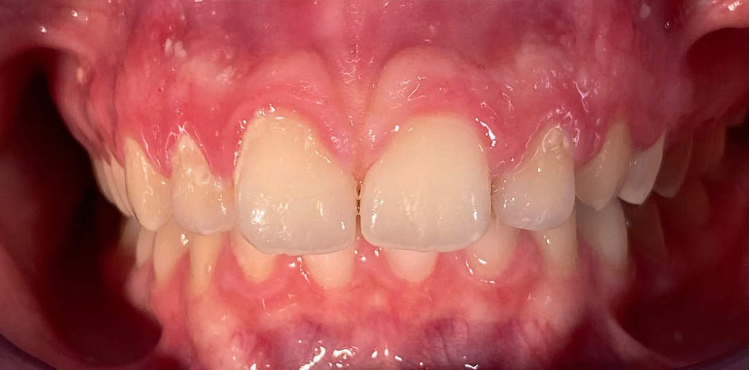 Ústna dutina po 3 mesiacoch dentosofie – detail zubov