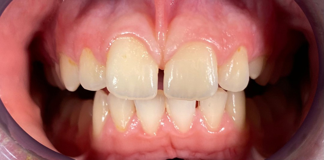 Ústna dutina pred dentosofiou – detail zubov