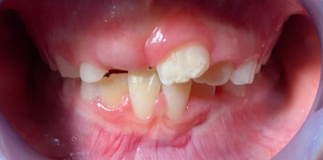 Detail zubov pred autoterapiou dentosofie