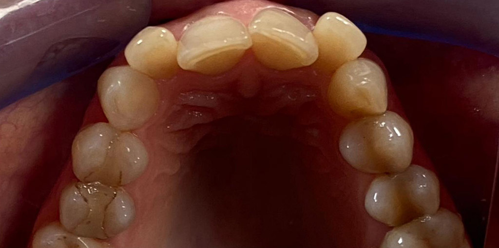 Zuby pred dentosofickou terapiou – detail úst